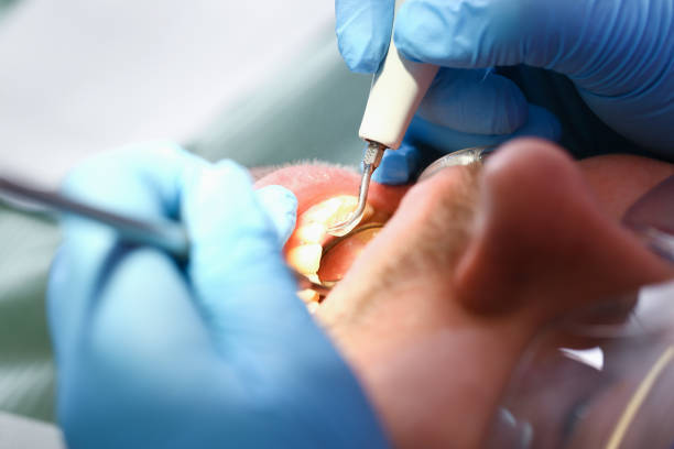 Best Emergency Dentist for Knocked-Out Tooth in Tremont, IL