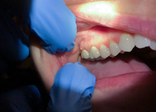 Best Emergency Dentist for Knocked-Out Tooth in Tremont, IL